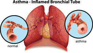 Asthma-Long-Term-Disability-Claims-Attorney