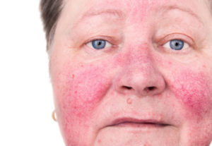 Skin-Disorder-Social-Security-Disability-Benefits