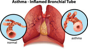 Asthma-Long-Term